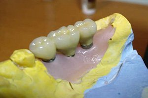 Имплантация зубов.jpg?v=0